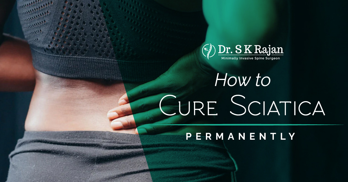 How to Cure Sciatica Permanently