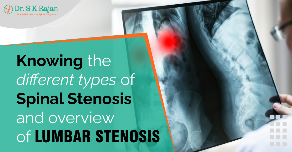 Different Types of Spinal Stenosis and overview
