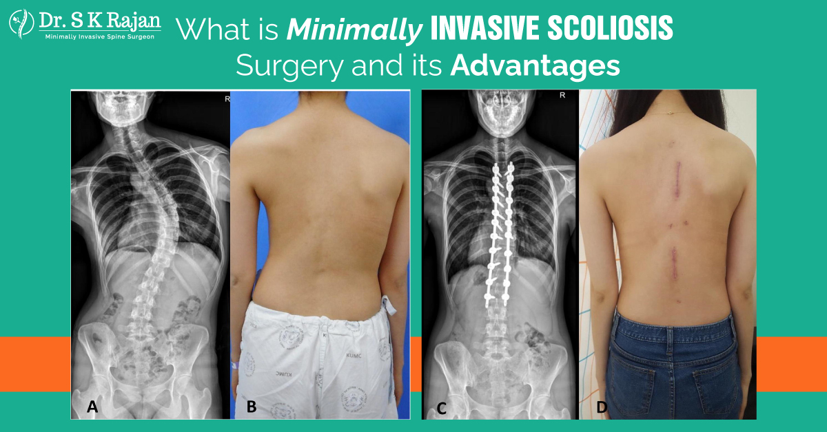 Minimally Invasive Scoliosis Surgery And Its Advantages