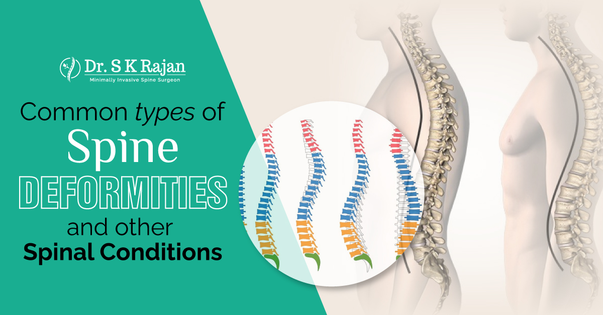 Common Types of Spine Deformities