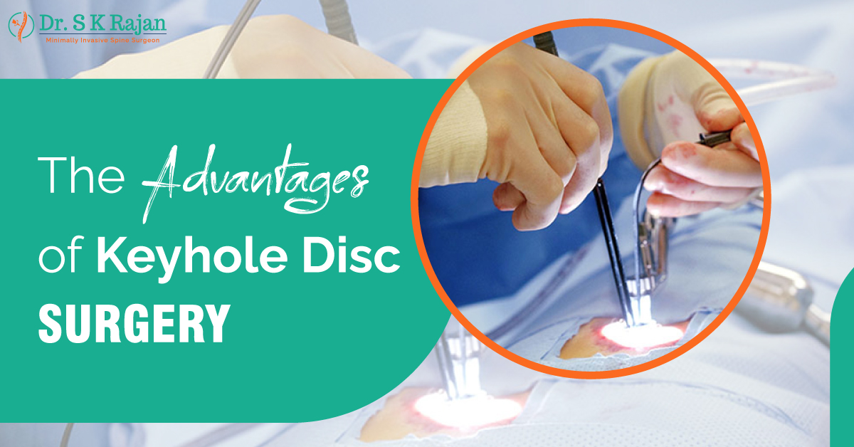Advantages Of Keyhole Disc Surgery