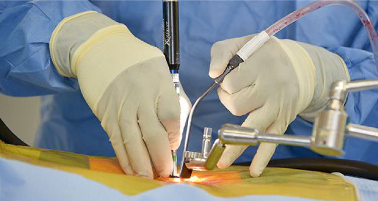 Conventional Open Spine Surgery In Gurgaon Conventional Open Spine Surgery