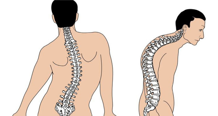 Scoliosis & Kyphosis Treatment in Gurgaon Best Scoliosis Surgery In Gurgaon