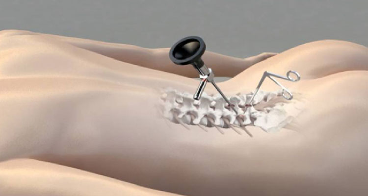Endoportal/Endoscopic Spine Surgery in Gurgaon Endoportal/Endoscopic Spine Surgery