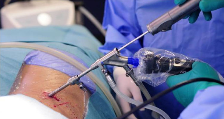 Endoscopic Discectomy Treatment in Gurgaon : Dr. S K Rajan Endoscopic Discectomy Treatment in Gurgaon : Dr. S K Rajan