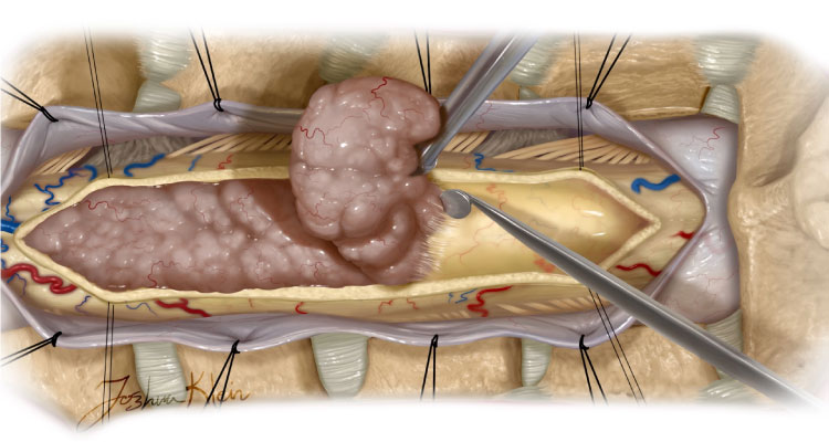 Endoscopic Removal of Spinal Tumours in Gurgaon : Dr S K Rajan