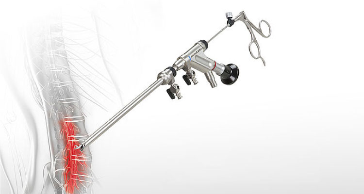Endoscopic Spinal Stenosis Decompression Treatment Endoscopic Spinal Stenosis Decompression Surgeon in Gurgaon