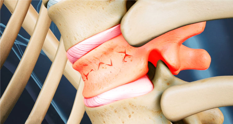 Fracture Treatment in Gurgaon spinal fracture treatment in Gurgaon