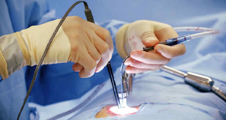 Keyhole Spine Surgery in Gurgaon Keyhole Spine Surgery