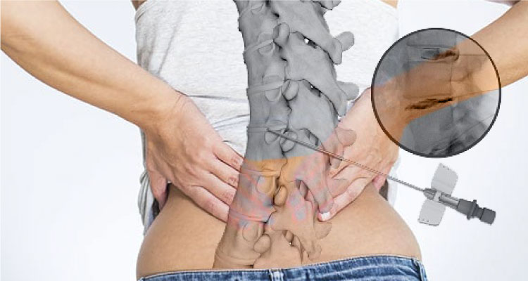 Discogram Surgeon In Gurgaon | Lumbar Discography Diagnosis