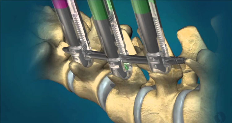 Percutaneous Screw Fixation Surgeon in Gurgaon