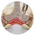 Endoscopic Spinal Stenosis