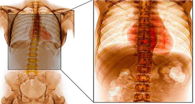 spinal cord tuberculosis treatment  in gurgaon