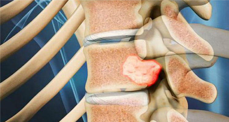 Bone Tumor & Nerves Treatment/Surgery In Gurgaon Nerve Tumor Treatment In Gurgaon